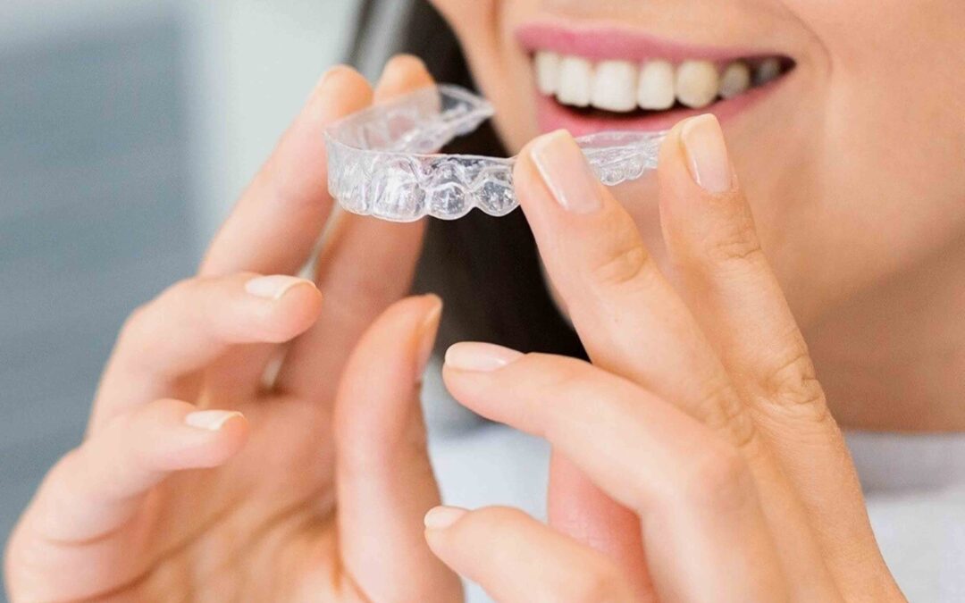 clear aligners