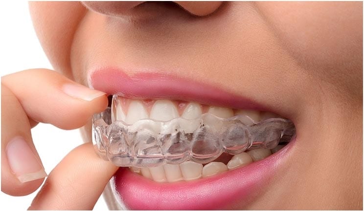 Clear Aligners for a Perfect Smile at Midclinic Dubai