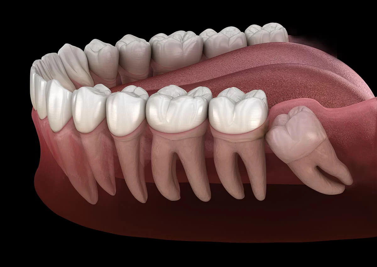 Urgent Wisdom Teeth Removal: Costs and Procedures