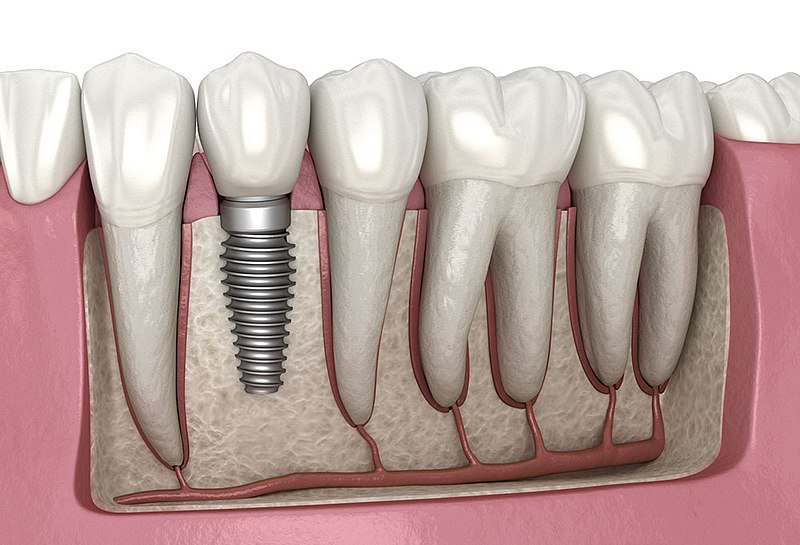 Dental implant